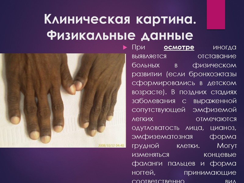 Клиническая картина. Физикальные данные При осмотре иногда выявляется отставание больных в физическом развитии (если